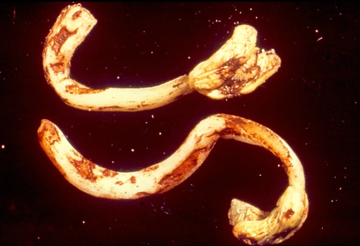 Brown, sunken lesions on bean seedlings, identified by the source as Rhizoctonia disease.